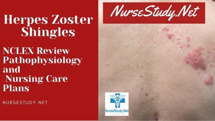 Nursing diagnosis for herpes zoster